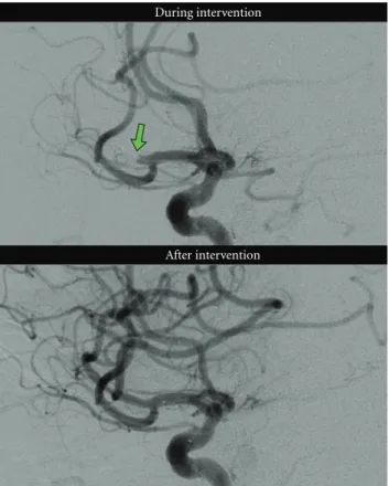Figure 3: Case 1: DSA images from the right anterior cerebral circulation. The microcatheter is seen in an occluded M2-segment of the right MCA (arrow) during the intervention