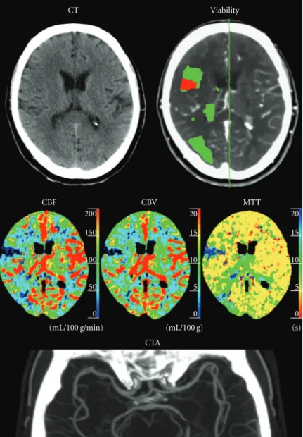 Figure 5: Case 2: 65-year-old male left-sided stroke symptoms and a normal NECT. The CTP viability map shows multiple perfusion defects (green) and a small area of advanced perfusion deficit (red) in the right hemisphere consistent with fragmented cardioge