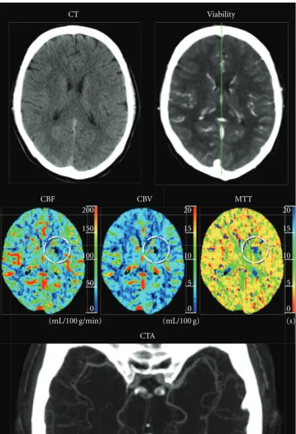 Figure 7: Case 3: 49-year-old male with right sided stroke symptoms and a normal NECT