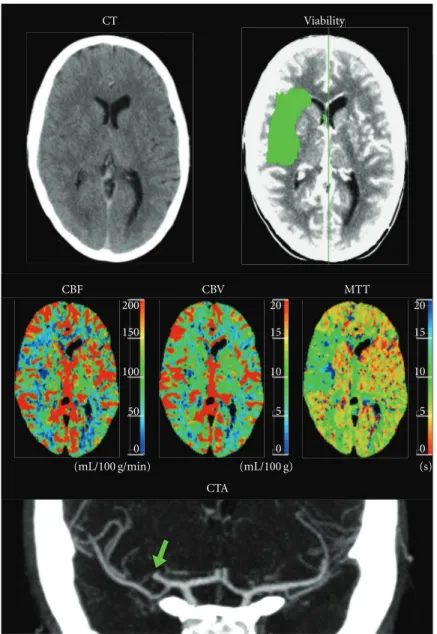 Figure 9: Case 4: 27-year-old woman with left-sided stroke symptoms of unknown onset and a normal NECT
