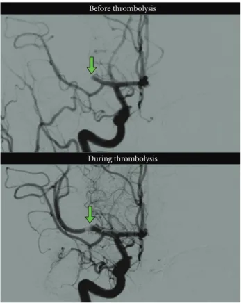 Figure 12: Case 4: follow-up MRI with FLAIR, DWI, ADC showing a relatively small infarction with minor hemorrhage in the right basal ganglia in comparison to the large penumbra seen on the initial CTP examination