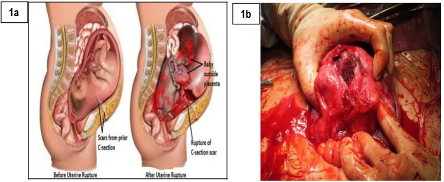 Figure 1a and1b: before and after uterine rapture and its surgery3 