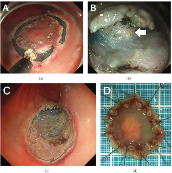 Figure 2: Images during the endoscopic submucosal dissection (ESD). After marking, a circumferential incision is made around the lesion(a)
