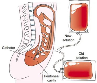 Fig. 6: Schematic diagram of a haemodialysis system. The blood compartment and dialysis solution compartment are separated by a cellophane membrane