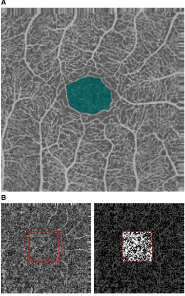 Fig 1. FAZ identification and choriocapillaris binarization. Fig 1.A shows an example of normal superficialvascular layer of the retina