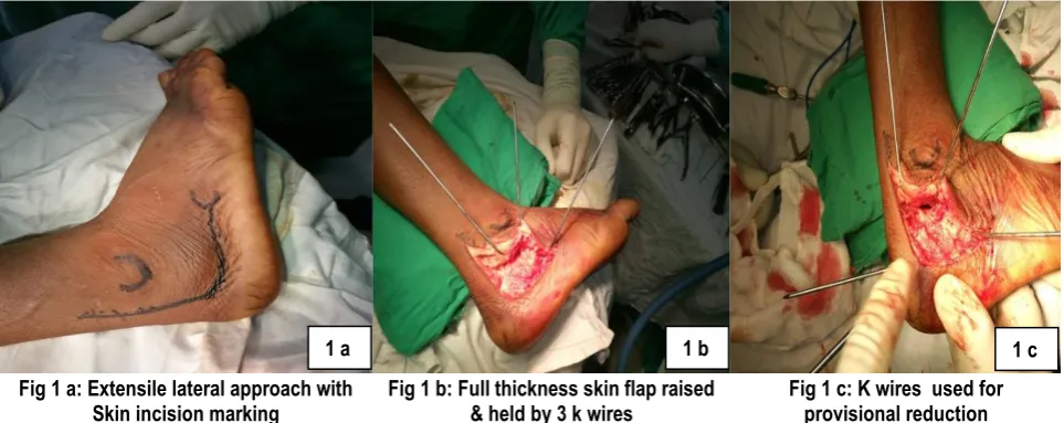 Fig 1 a: Extensile lateral approach with Skin incision marking 