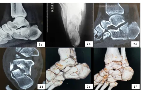 Fig 2 (a-f): Preoperative X-rays and CT Scans 
