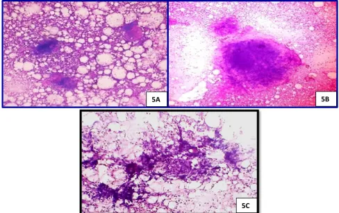 Figure 4; Case graded as C3. 4a, b: FNAC smears showing nucleated and anucleate squamous cells along with benign dual population ductal and myoepithelial cells.(LG x 100) 4c,d: Histopathology of same case  showing epidermoid cysts and chondrosarcomatous area.(H & E x 100 and 400) 