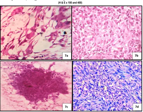 Figure 6: Histopathology of the case shown in figure 5 shows well differentiated chondrosarcomatous areas  