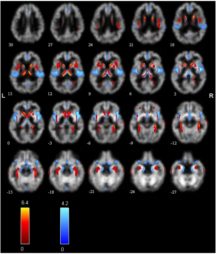 Figure 4. Sources discovered between groups MCI and HC. Red, component 5; blue, component 10.