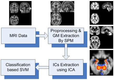 Figure 1. The framework of the whole processing. First, all MR images are normalized into a template, then seg-mented and smoothed