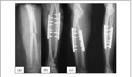 Figure 1.3 Internal fixator to fix fractures in bones of the forearm  [12]