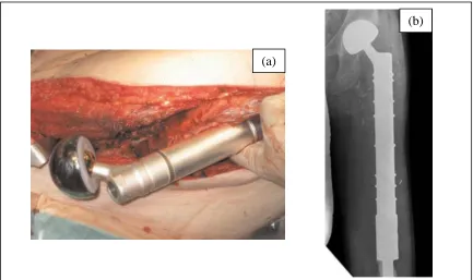 Figure 2.3(a) MUTARS®Silver silver-coated proximal femur replacement with a bipolar cup, and (b) post-operative x-ray of the megaendoprosthesis [72] 