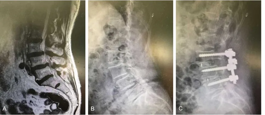 Figure 2. Results of radiographic examination of the lumbar fusion group. A: Preoperative sagittal MRI; B: Preopera-tive lateral radiographs; C: Postoperative lateral radiographs at the final follow-up.