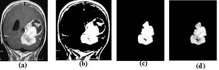 Figure 5(a): original image, 5(b) Threshold image, 5(c):Segmented image, 5(d): Fuzzy Cmeans 