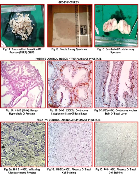 Fig 1A: Transurethral Resection Of 