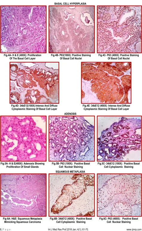 Fig.4A- H & E (400X): Proliferation  