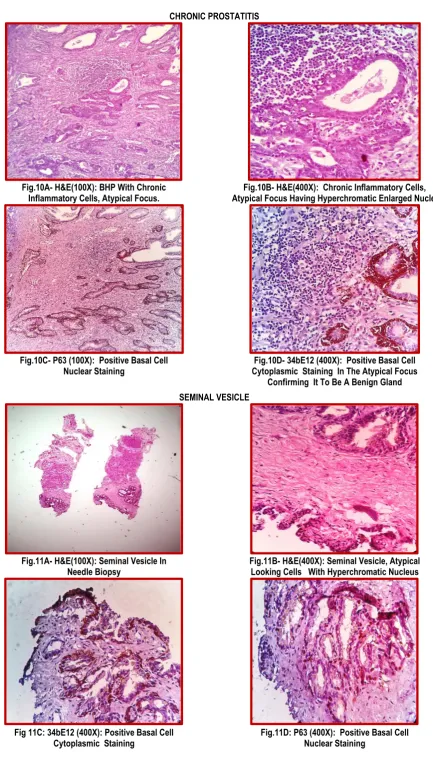 Fig.10A- H&E(100X): BHP With Chronic  