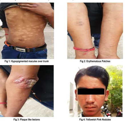 Fig 1: Hypopigmented macules over trunk  