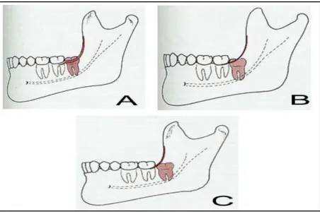 Figure 1: Winter’s classification of third molars: A) Mesioangular, B) Distoangular, C) Vertical, and D) Horizontal12