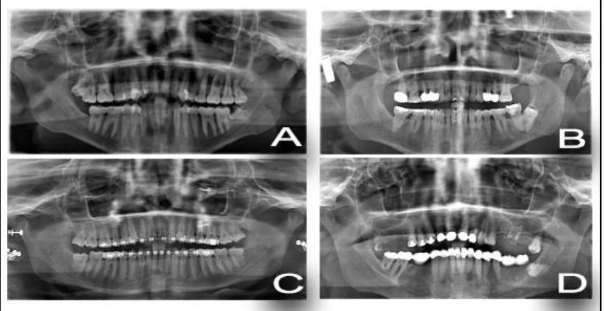 Table 5: Differences among patients according to Pell and Gregory classification 
