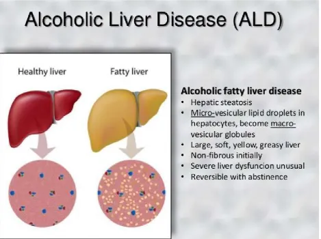 Fig. No. 02: Alcoholic liver diseases.