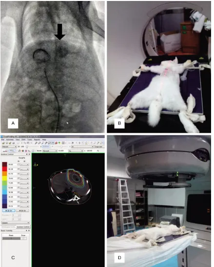 Figure 1. A. 3F microcatheter and injection of lipiodol in the left hepatic artery revealed ill-defined hypervascularity tumor staining in the left lobe