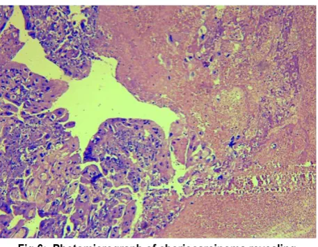 Fig 5: Gross: Diffuse haemorrhagic friable mass of choriocarcinoma in uterine cavity. 