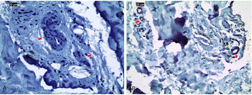 Figure 2. A. Positive staining is observed in a few vascular walls, idiopathic CTS (arrows), Collagene type I ×40; B