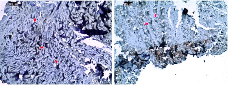 Figure 4. A. Positive staining is observed in the subsynovial connective tissue (arrows), idiopathic CTS Collagene Type III ×10