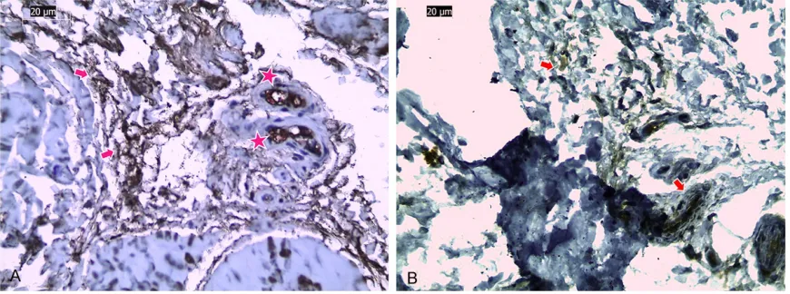 Figure 6. A. Intensive positive staining is observed in the subsynovial connective tissue (arrows) and vascular walls (stars), idiopathic CTS TGF-β ×40
