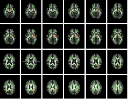 Figure 5. Dominant regions with reduced FA value in the left hemeisphere of bvFTD patients as compared with HC (Mirror image, The right side is actually the left, uncorrected, P<0.05)