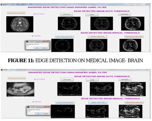 FIGURE 11: EDGE DETECTION ON MEDICAL IMAGE- BRAIN  