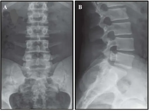 Figure 1:  Plain x-ray for one of the subject:  