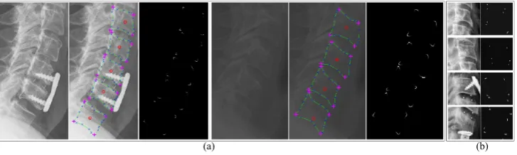 Figure 1: (a) Zoomed X-ray images (left), manual annotations (middle): center (o), manuallyclicked boundary points (x), corner points (+) and splined vertebrae curve (-) and cornerdistributions (right) (b) Image patches and patch level ground truth probability distribution.