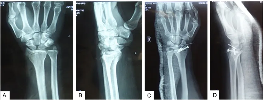 Figure 1. Representative of dorsal trans-radial perilunate dislocations. Preoperative posteroanterior (PA) (A) and lateral (B) views; postoperative PA (C) and lateral (D) views