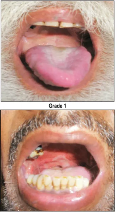 Figure 1: Various types of mucocitis  