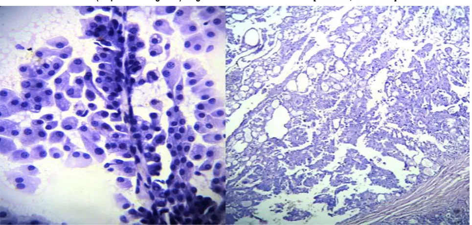 Figure 2: (A) Hypercellular smears containing small dark basaloid cells and abundant hyaline material in a case of  basal cell adenoma, misinterpreted as adenoid cystic carcinoma [40X view, H & E stain]