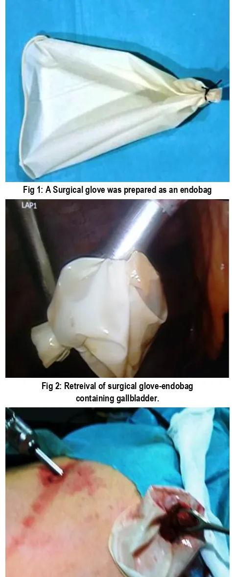Fig 1: A Surgical glove was prepared as an endobag 