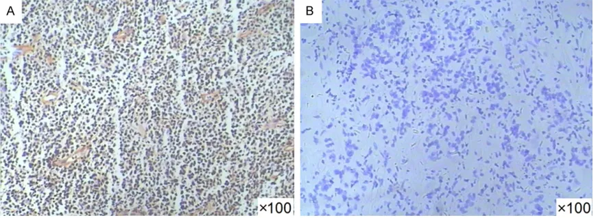 Figure 1. The expression of EBV-encoded small RNA1 in specimens was detected usingIn situ hybridization