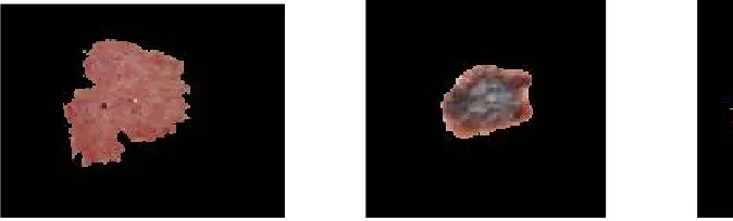 Figure 1.  Segmentated Images of Various Skin Lesions 