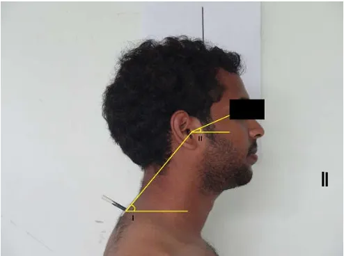 Figure 1. Angle I: Line connecting C7ear and horizontal line (Lower cervical Angle - LCA)