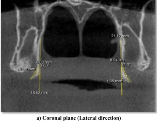 Table 1.  Mean measurements with standard deviations (SD) of Pterygoidhamulus( PH )  of different parameters of left sTable 1