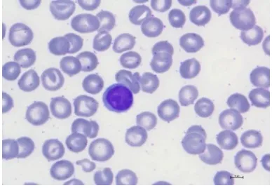 Figure-5:     a) CLL Image                                                         b) Normal Lymphocyte Image 