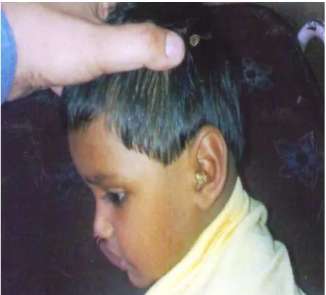 Fig 3:  A child with foreign body (cotton) ear 