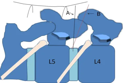 Figure 1. A: Traditional Yeung’s insertion technique. B: Modified insertion technique.
