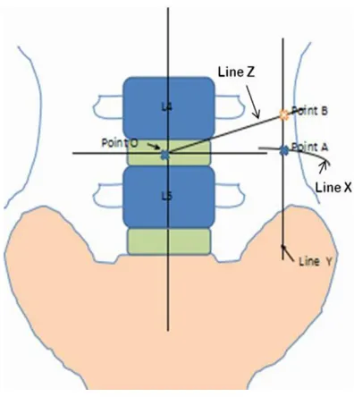 Figure 2. The intra-operative postero-anterior imag-ing was taken to identify the midline, one line being parallel with the L4/5 disc and the intersection point O