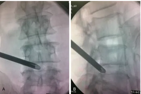 Figure 4. The traditional approach for Yeung’s technique. (A) Intra-operative posteroanterior and (B) lateral fluoroscopic imaging showing the Yeung’s cannula insertion technique.