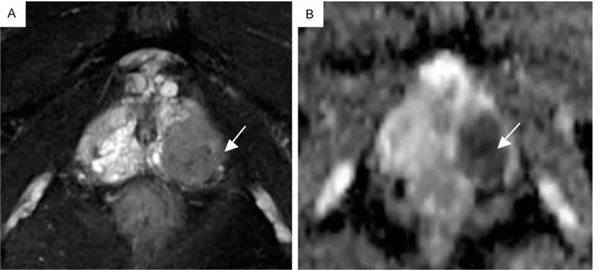 Figure 1. A 78-year-old patient with a serum PSA level of 60 ng/mL. Both T2W imaging (A) and the ADC map (B) mmshowed a hypointense area in the left peripheral zone (arrow)