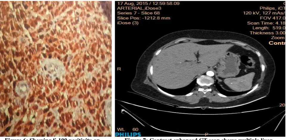 Figure 7: Contrast enhanced CT scan shows multiple liver metastasis spread throughout the liver parenchyma